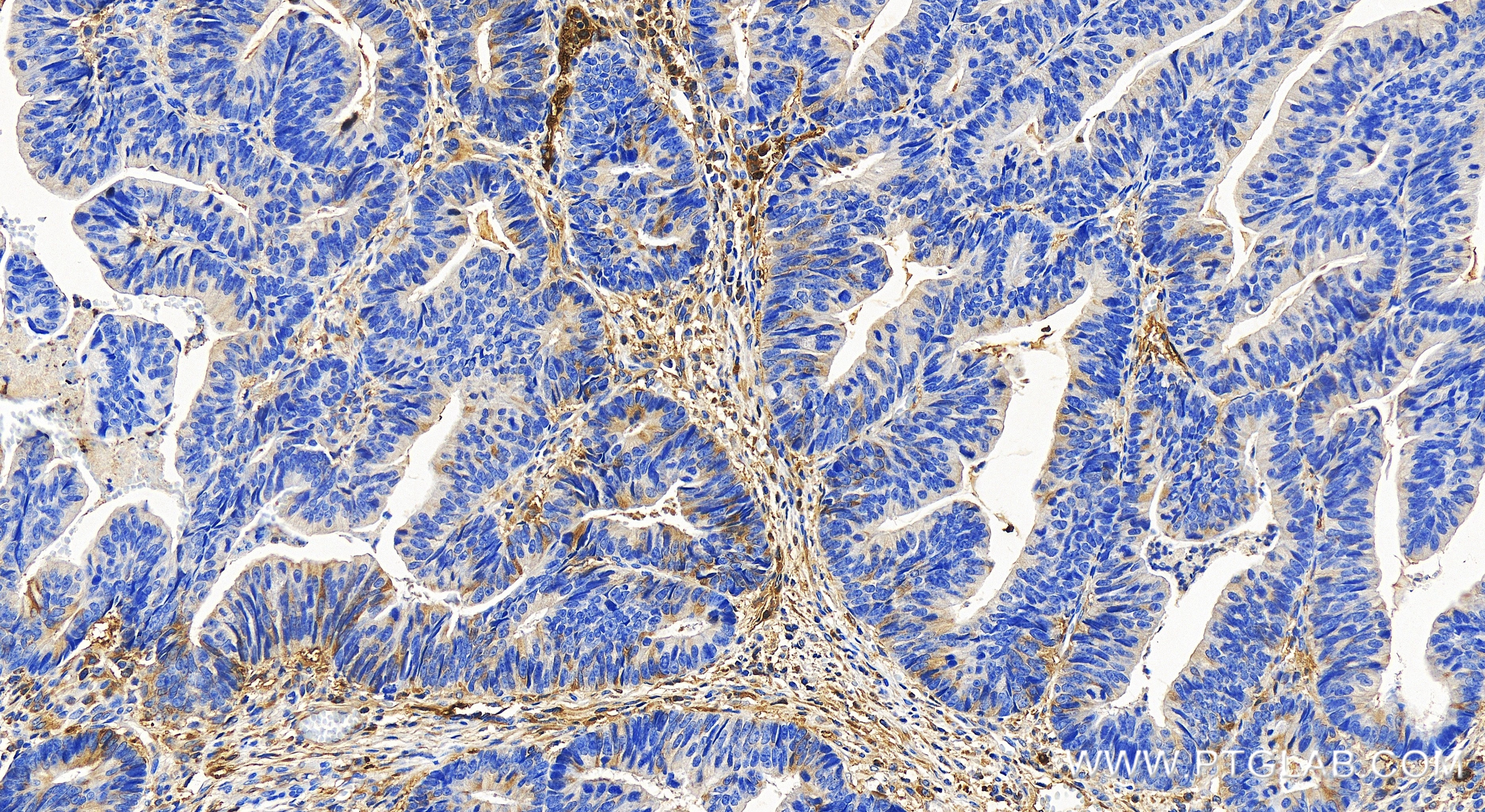 Immunohistochemistry (IHC) staining of human colon cancer tissue using Tetranectin Recombinant antibody (85689-5-RR)
