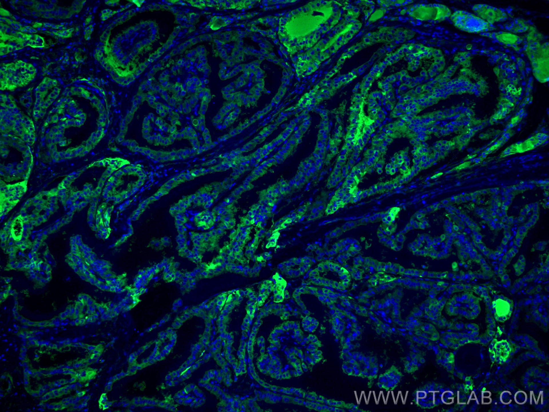 Immunofluorescence (IF) / fluorescent staining of human thyroid cancer tissue using CoraLite® Plus 488-conjugated Thyroglobulin Monocl (CL488-60272)