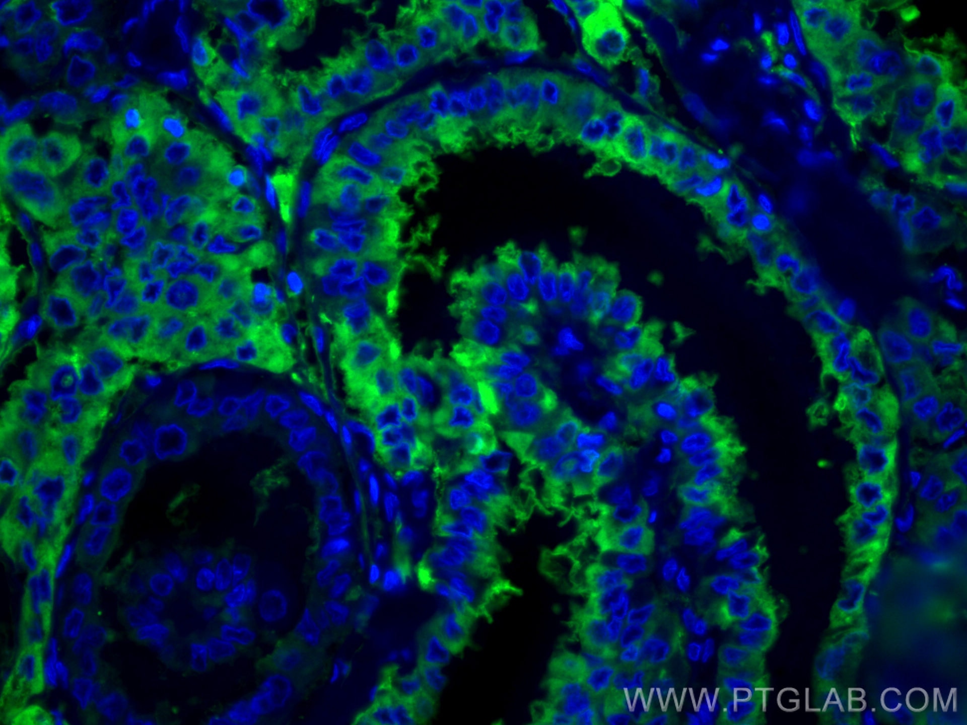 IF Staining of human thyroid cancer using CL488-60272