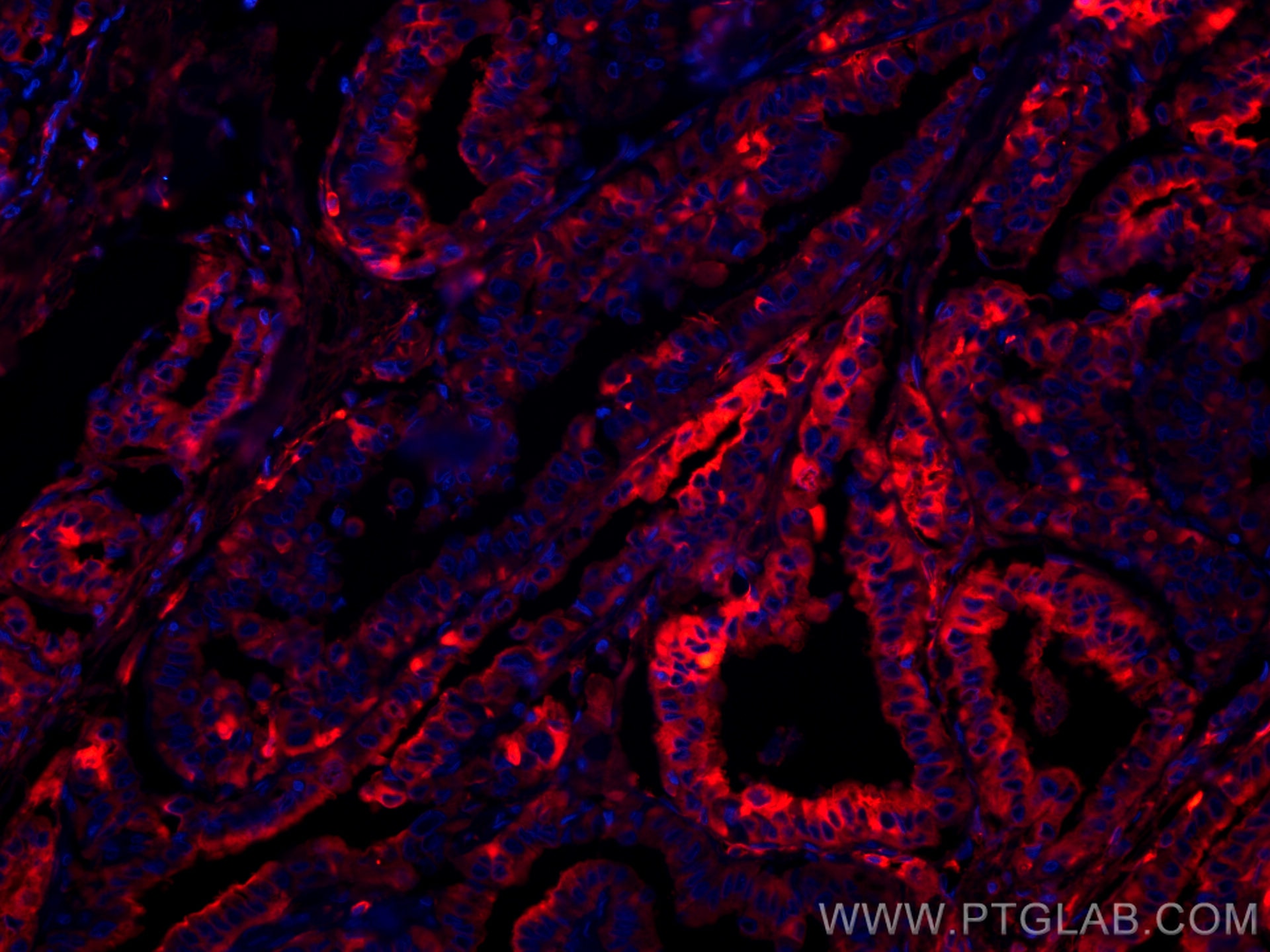 Immunofluorescence (IF) / fluorescent staining of human thyroid cancer tissue using CoraLite®594-conjugated Thyroglobulin Monoclonal a (CL594-60272)