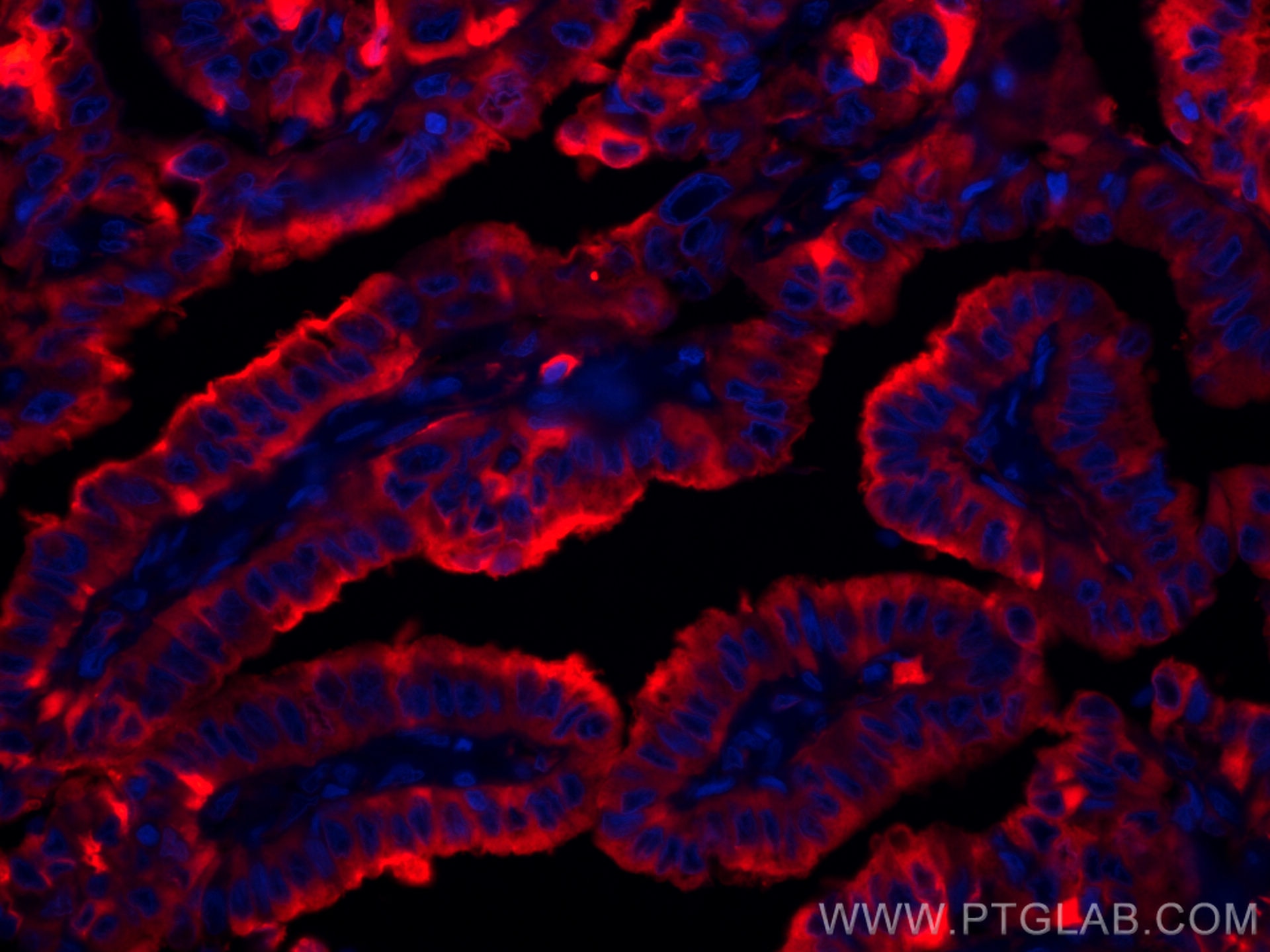 Immunofluorescence (IF) / fluorescent staining of human thyroid cancer tissue using CoraLite®594-conjugated Thyroglobulin Monoclonal a (CL594-60272)