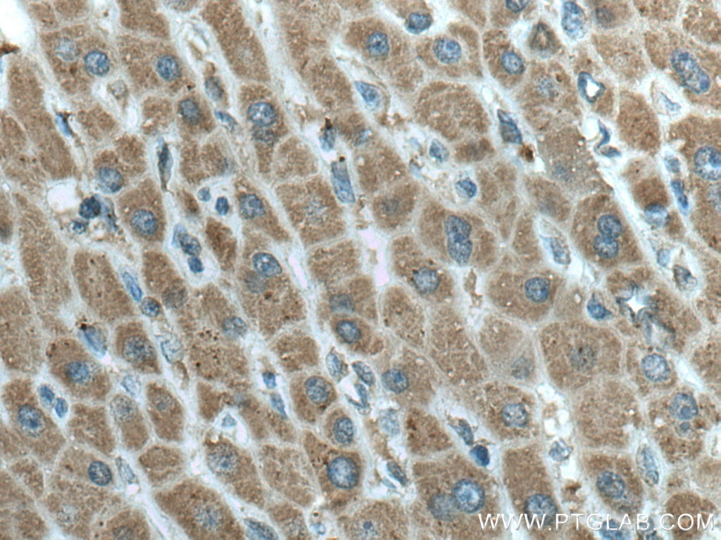 Immunohistochemistry (IHC) staining of human liver cancer tissue using Tim23 Monoclonal antibody (67535-1-Ig)