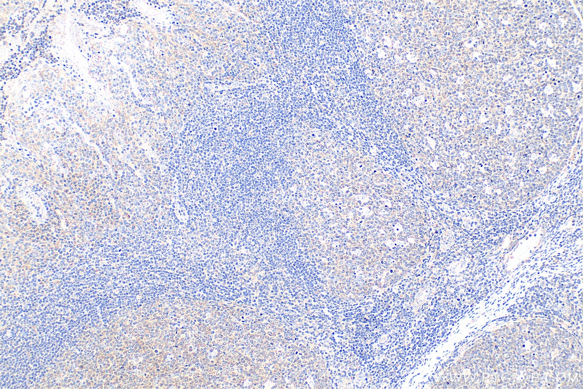 Immunohistochemical analysis of paraffin-embedded human tonsillitis tissue slide using 83627-1-RR (Timp-3 antibody) at dilution of 1:400 (under 10x lens). Heat mediated antigen retrieval with Tris-EDTA buffer (pH 9.0). Immunohistochemistry (IHC) staining of human tonsillitis tissue using Timp-3 Recombinant monoclonal antibody (83627-1-RR)