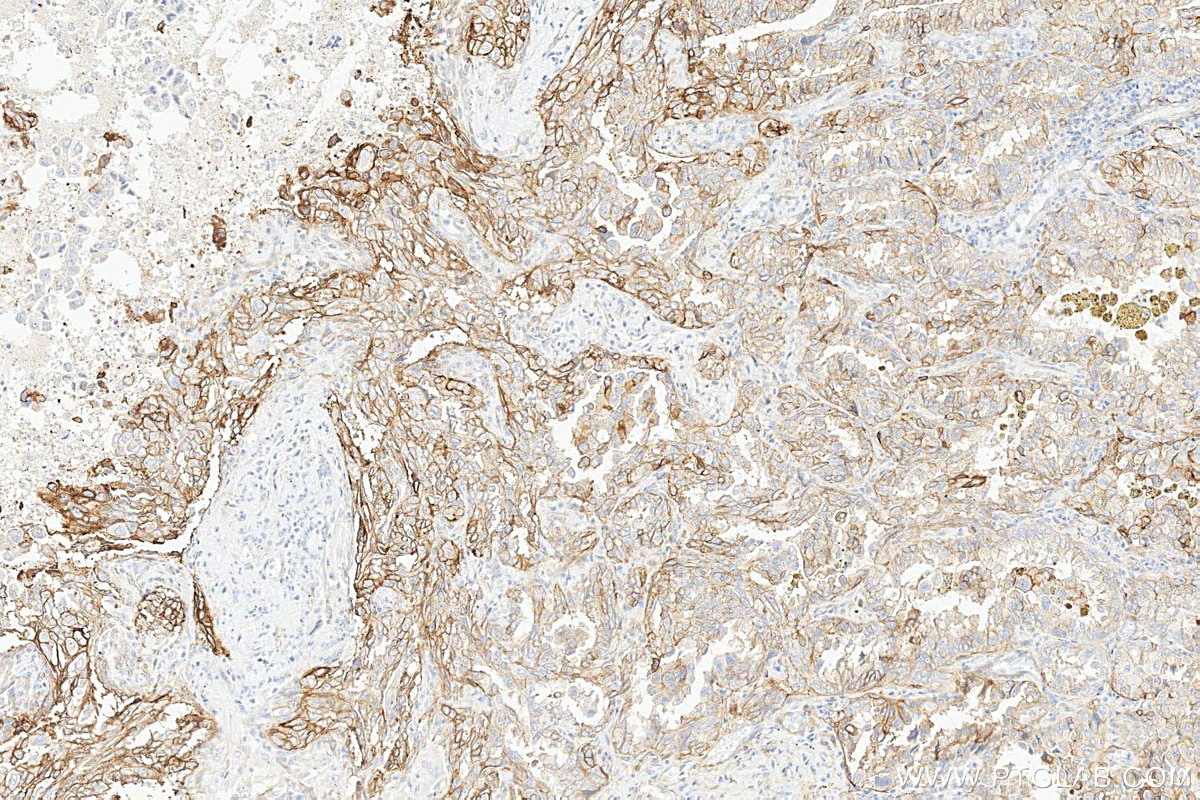 IHC staining of human lung cancer using 31453-1-AP Immunohistochemistry (IHC) staining of human lung cancer tissue using Tissue Factor/CD142 Polyclonal antibody (31453-1-AP)