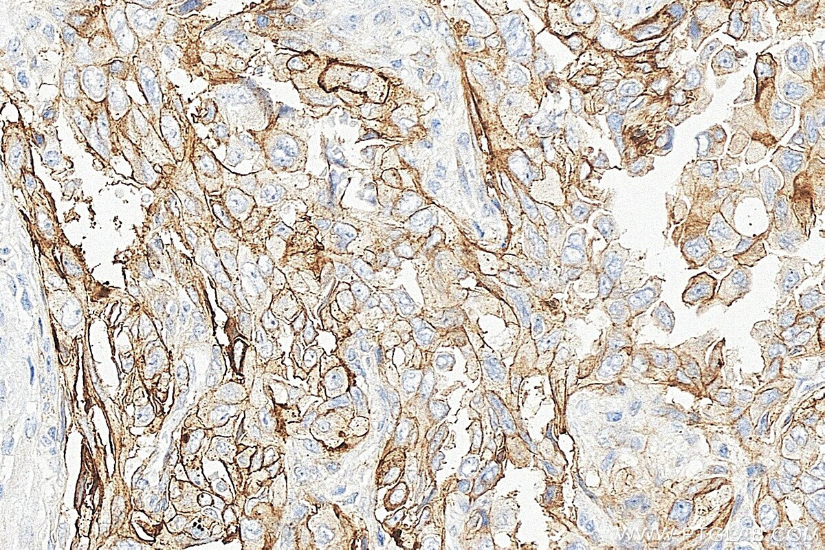 IHC staining of human lung cancer using 31453-1-AP Immunohistochemistry (IHC) staining of human lung cancer tissue using Tissue Factor/CD142 Polyclonal antibody (31453-1-AP)