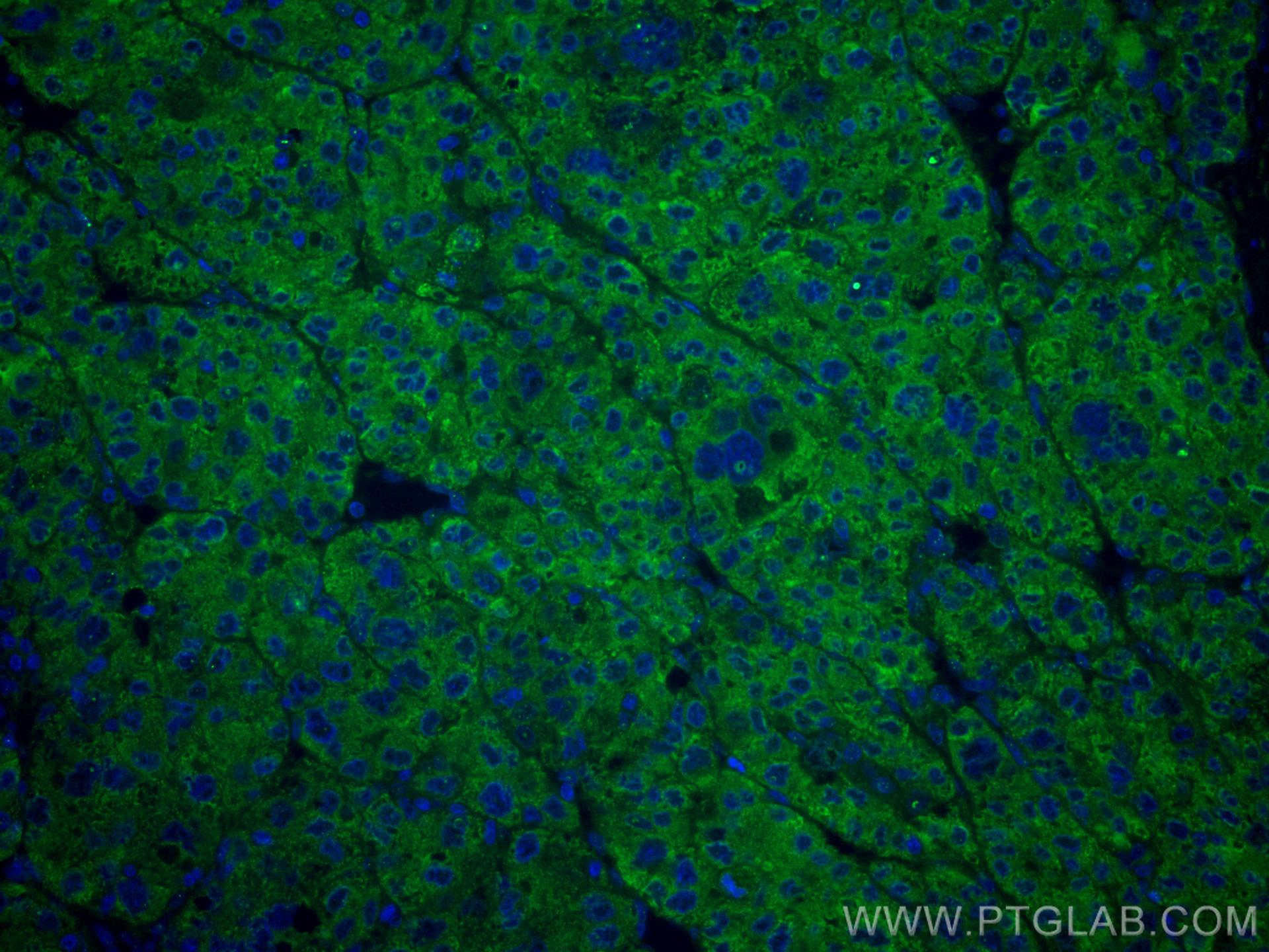 Immunofluorescence (IF) / fluorescent staining of human liver cancer tissue using CoraLite® Plus 488-conjugated Transferrin Monoclon (CL488-66171)