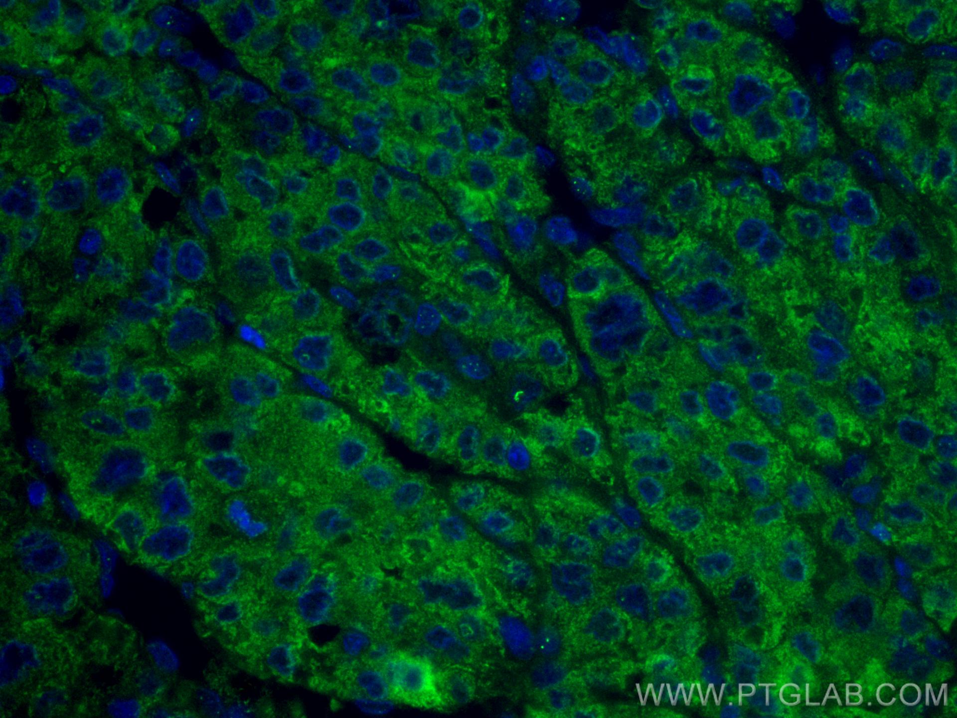 Immunofluorescence (IF) / fluorescent staining of human liver cancer tissue using CoraLite® Plus 488-conjugated Transferrin Monoclon (CL488-66171)