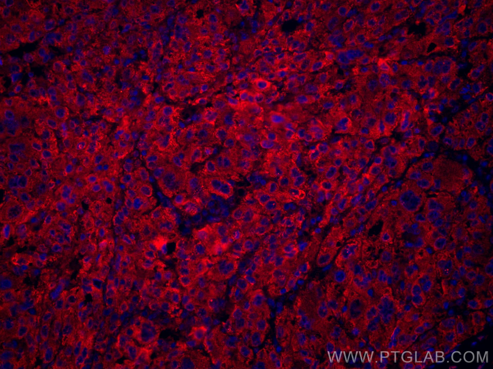 Immunofluorescence (IF) / fluorescent staining of human liver cancer tissue using CoraLite®594-conjugated Transferrin Monoclonal ant (CL594-66171)