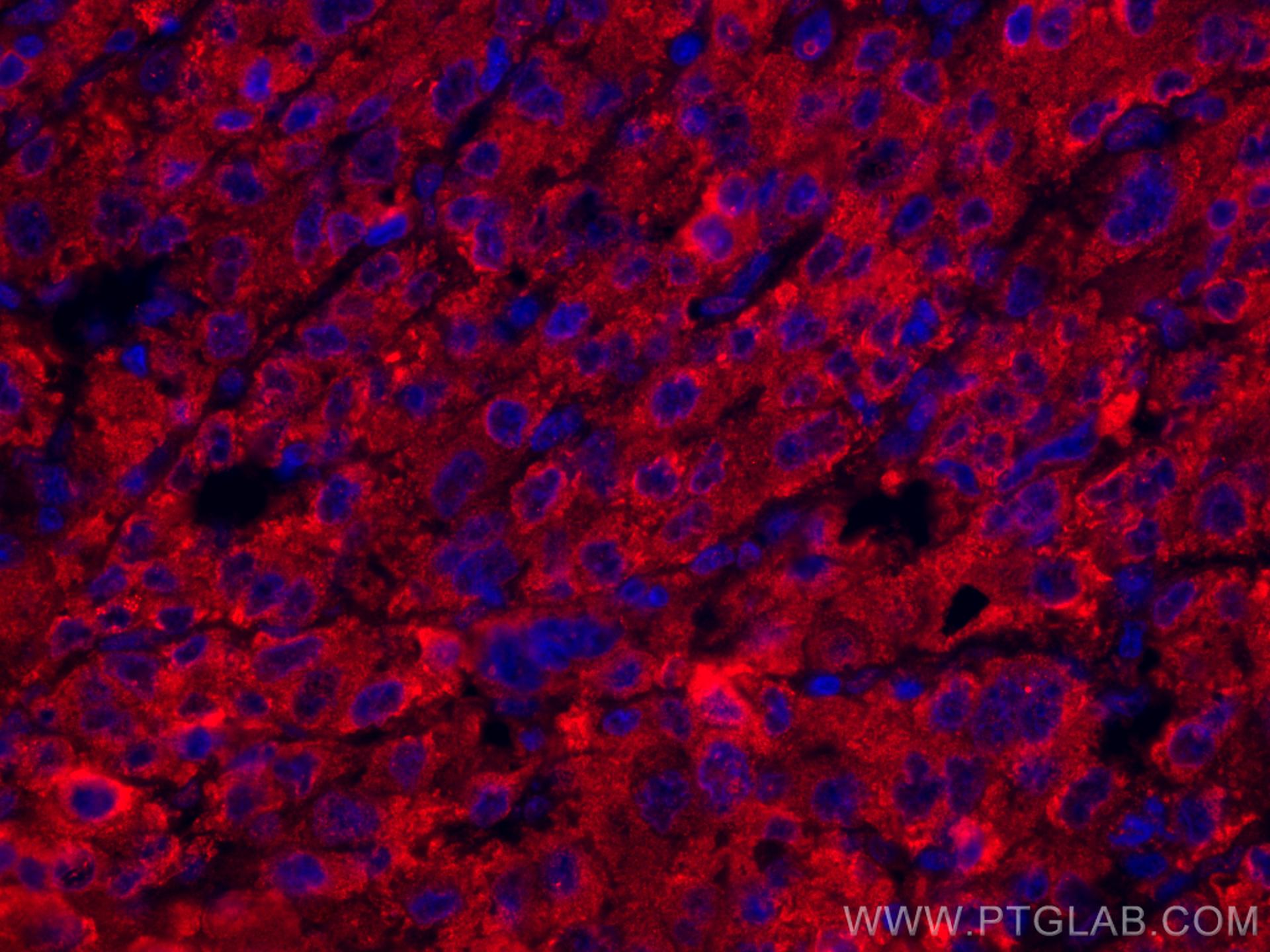 Immunofluorescence (IF) / fluorescent staining of human liver cancer tissue using CoraLite®594-conjugated Transferrin Monoclonal ant (CL594-66171)