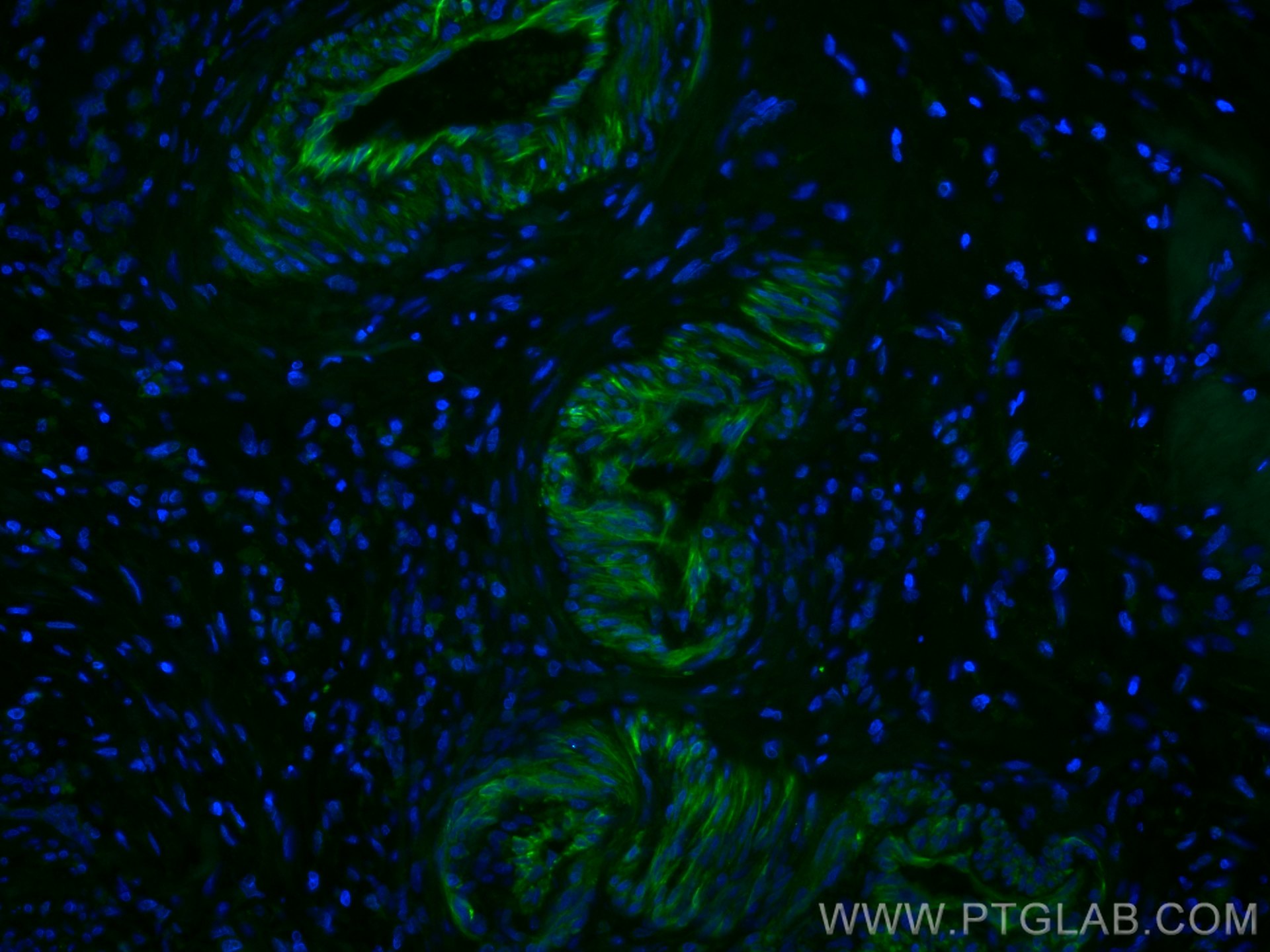 Immunofluorescence (IF) / fluorescent staining of human colon cancer tissue using CoraLite® Plus 488-conjugated Transgelin 2 Monoclo (CL488-60044)