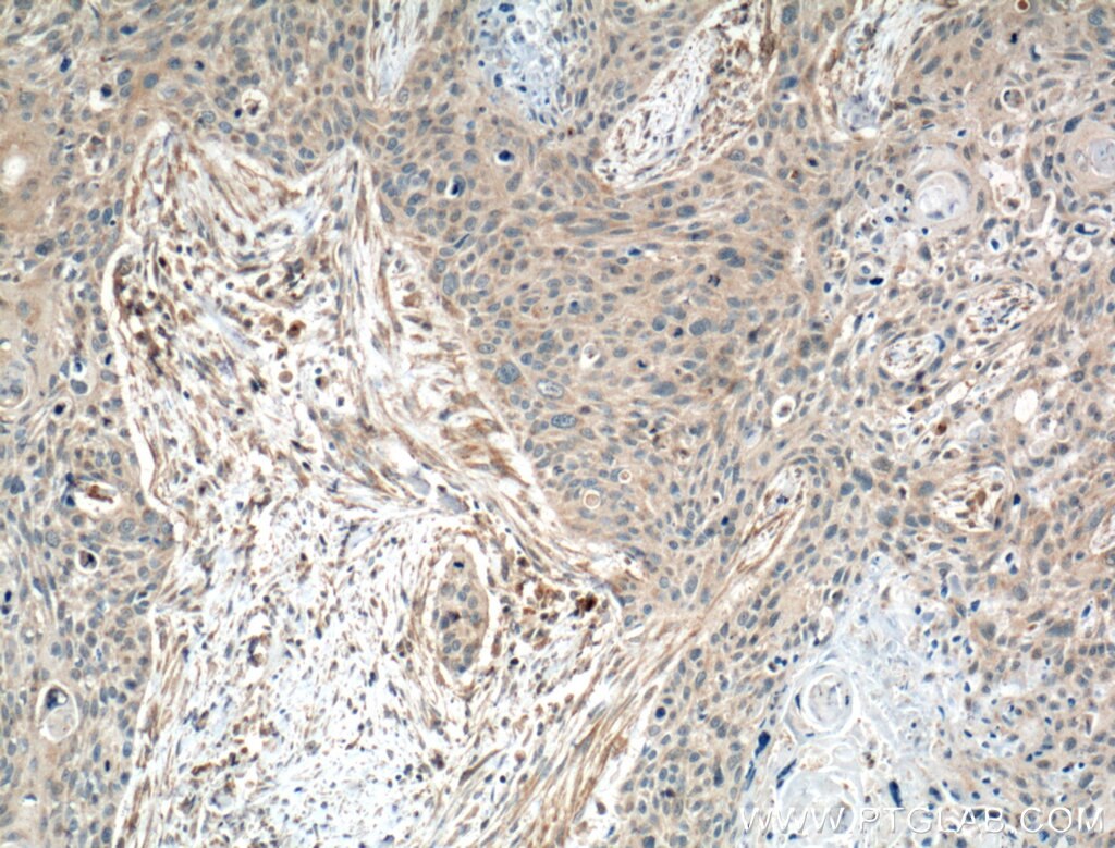 Immunohistochemistry (IHC) staining of human oesophagus cancer tissue using Transgelin-2-specific Polyclonal antibody (15508-1-AP)