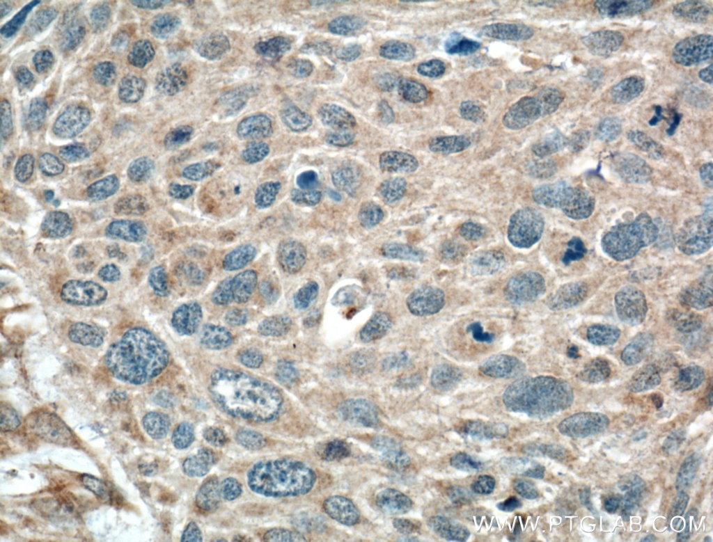 Immunohistochemistry (IHC) staining of human oesophagus cancer tissue using Transgelin-2-specific Polyclonal antibody (15508-1-AP)