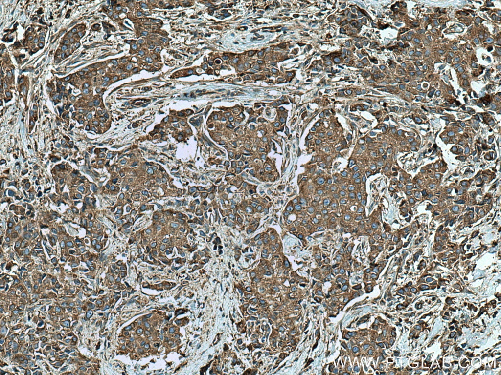 Immunohistochemistry (IHC) staining of human breast cancer tissue using Beta Tubulin Monoclonal antibody (66240-1-Ig)