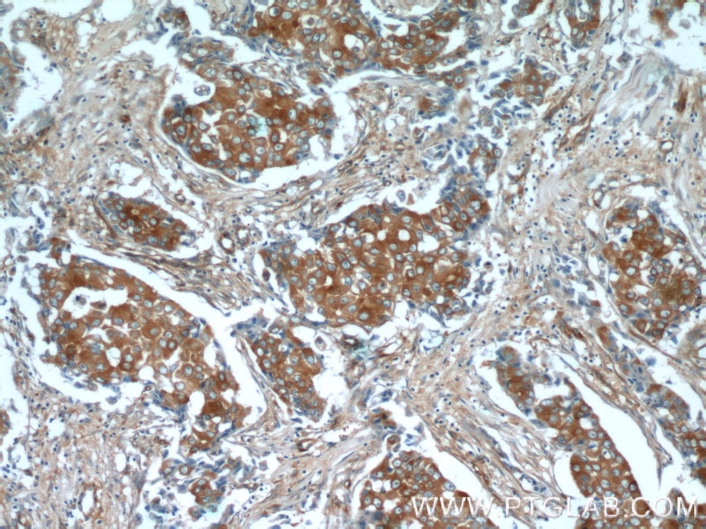 IHC staining of human breast cancer using 66240-1-Ig