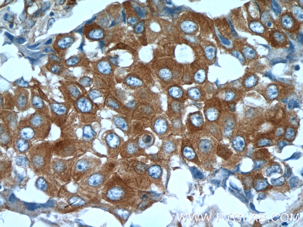 Immunohistochemistry (IHC) staining of human breast cancer tissue using Beta Tubulin Monoclonal antibody (66240-1-Ig)