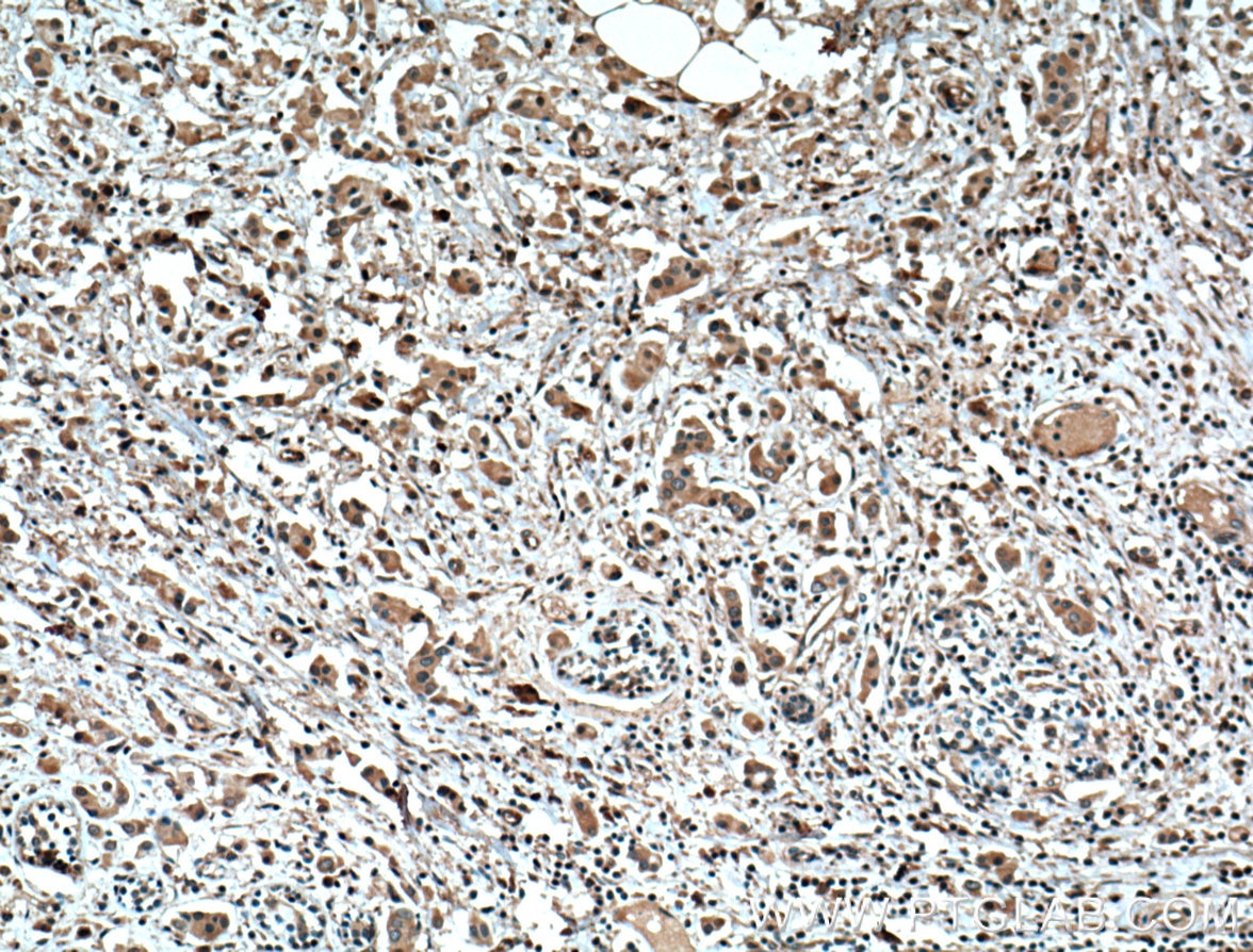 Immunohistochemistry (IHC) staining of human breast cancer tissue using Tubulin Beta Class V Monoclonal antibody (66362-1-Ig)