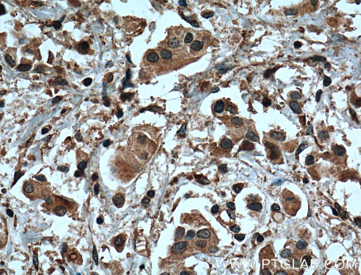 Immunohistochemistry (IHC) staining of human breast cancer tissue using Tubulin Beta Class V Monoclonal antibody (66362-1-Ig)