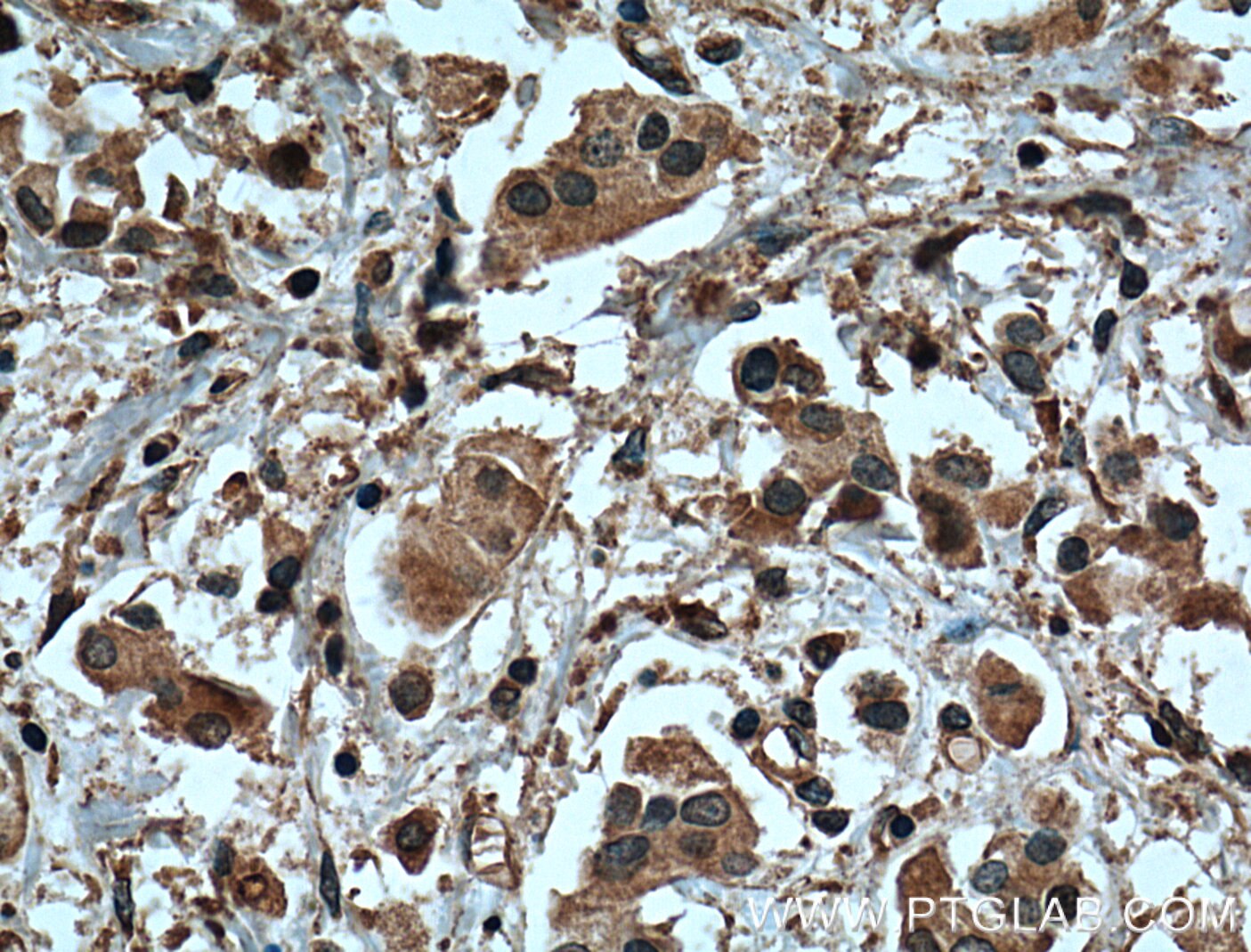 Immunohistochemistry (IHC) staining of human breast cancer tissue using Tubulin Beta Class V Monoclonal antibody (66362-1-Ig)