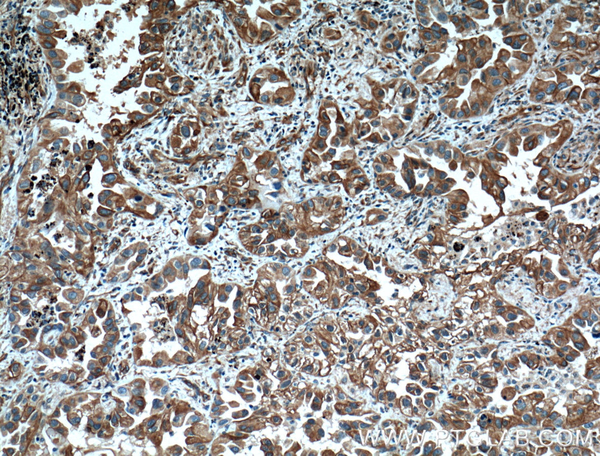 Immunohistochemistry (IHC) staining of human lung cancer tissue using Tubulin Beta Class V Monoclonal antibody (66362-1-Ig)