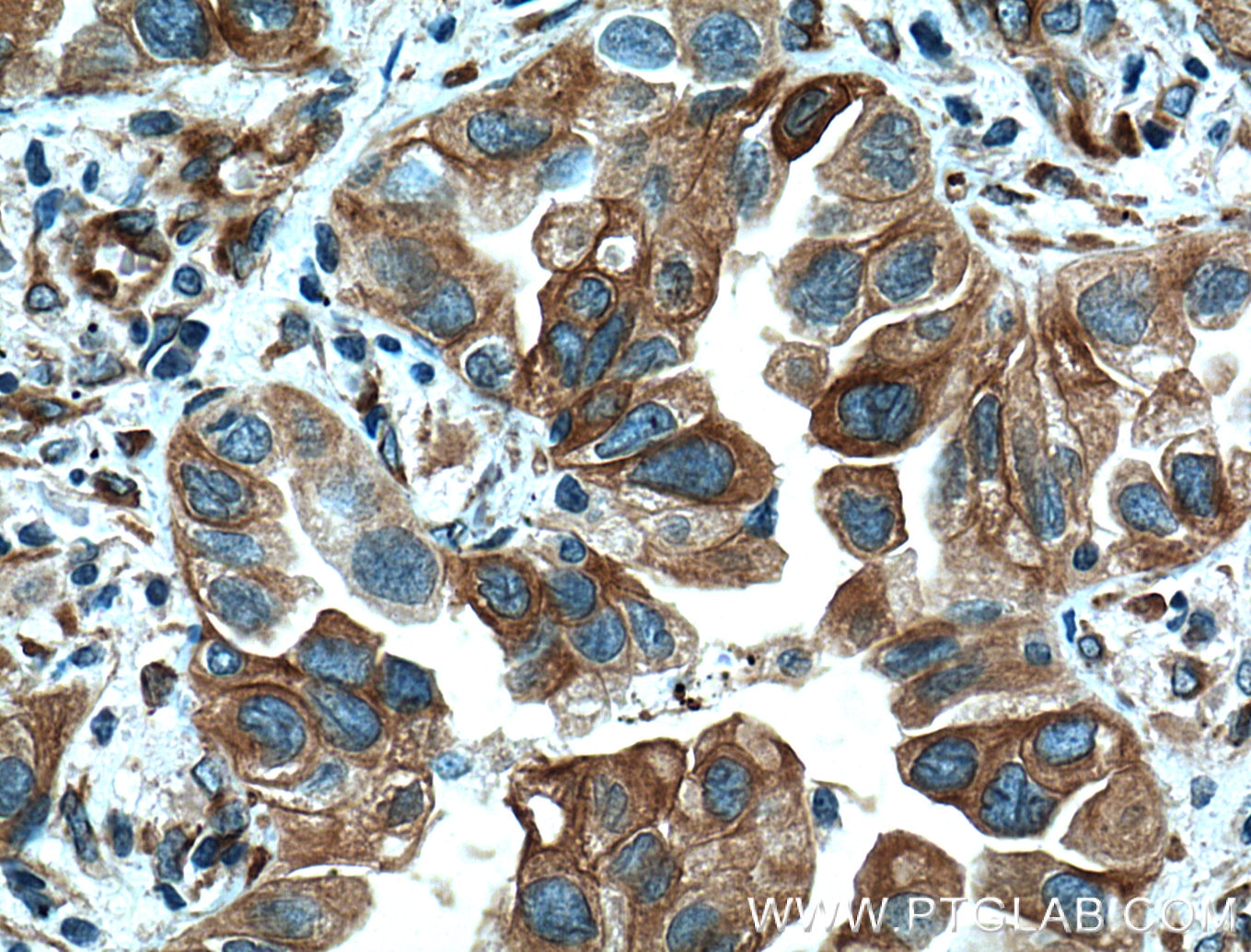 IHC staining of human lung cancer using 66362-1-Ig