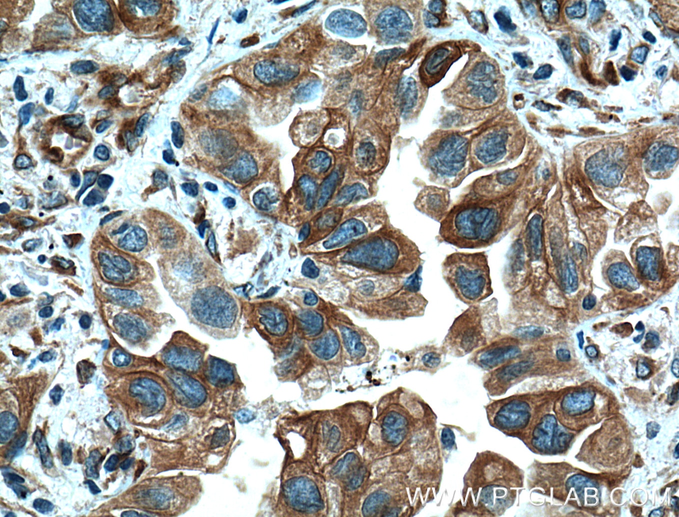 Immunohistochemistry (IHC) staining of human lung cancer tissue using Tubulin Beta Class V Monoclonal antibody (66362-1-Ig)