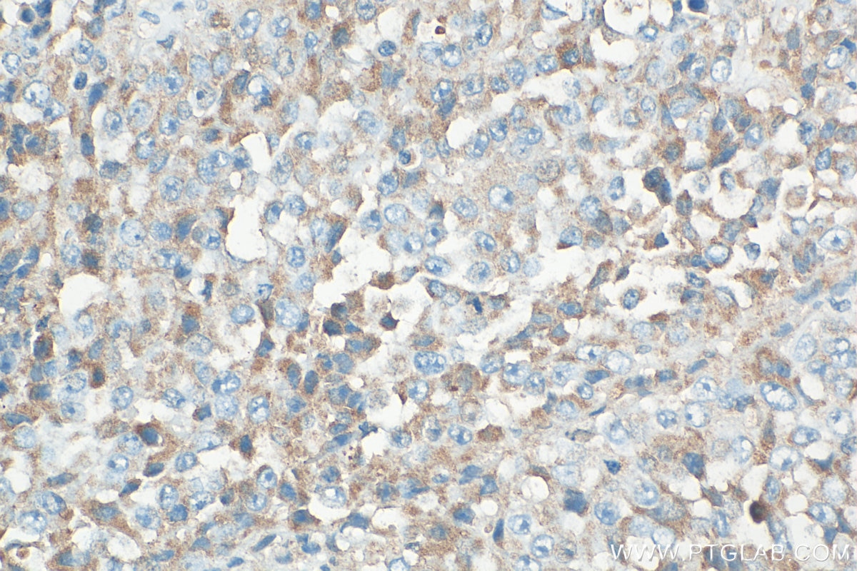 Immunohistochemistry (IHC) staining of human malignant melanoma tissue using Tyrosinase Polyclonal antibody (31291-1-AP)