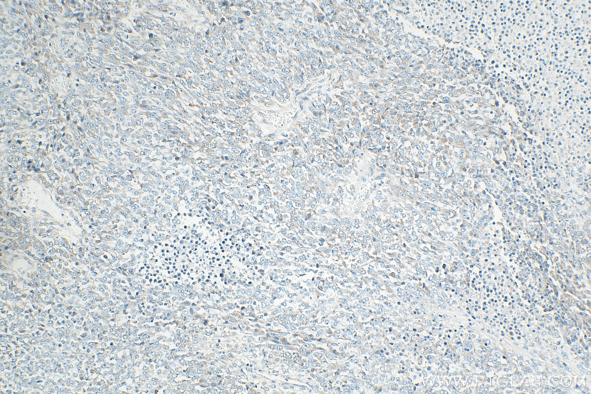 Immunohistochemistry (IHC) staining of human malignant melanoma tissue using Tyrosinase Polyclonal antibody (31291-1-AP)
