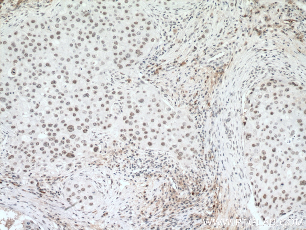Immunohistochemistry (IHC) staining of human breast cancer tissue using U2AF65 Polyclonal antibody (15624-1-AP)