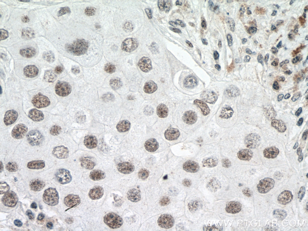 Immunohistochemistry (IHC) staining of human breast cancer tissue using U2AF65 Polyclonal antibody (15624-1-AP)