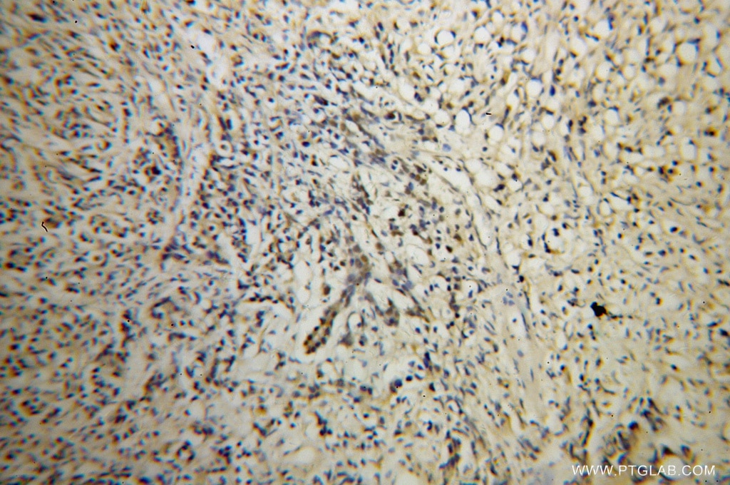 Immunohistochemistry (IHC) staining of human prostate cancer tissue using U2AF35 Polyclonal antibody (10334-1-AP)