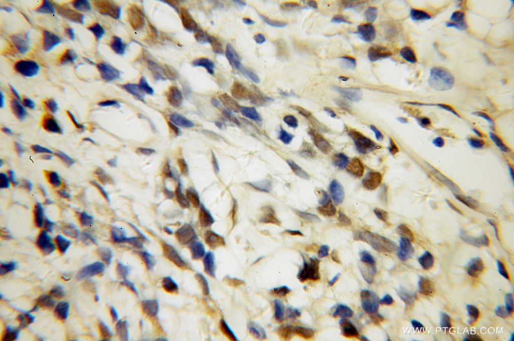 Immunohistochemistry (IHC) staining of human prostate cancer tissue using U2AF35 Polyclonal antibody (10334-1-AP)