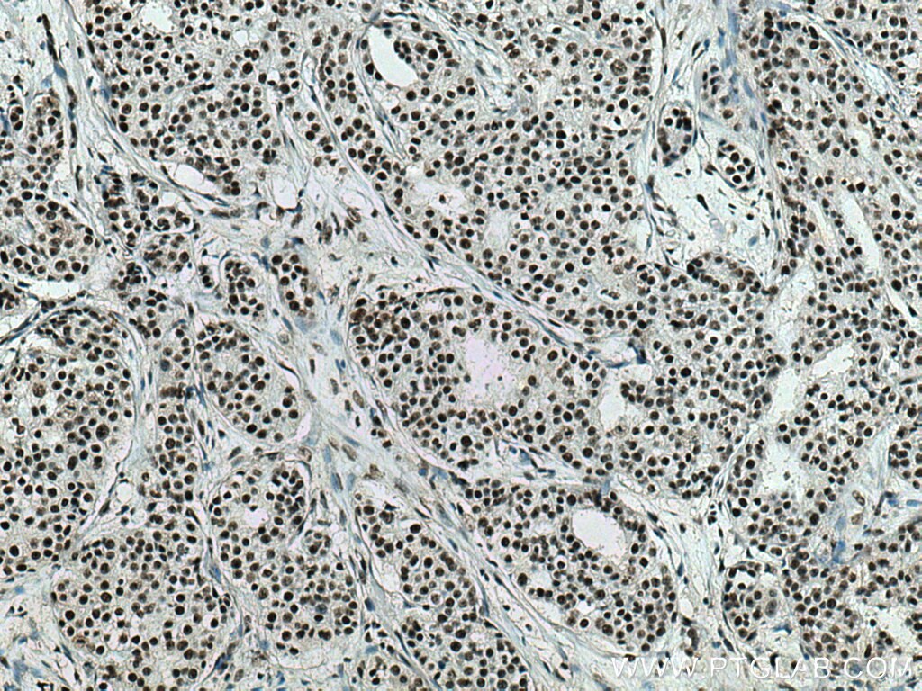 IHC staining of human breast cancer using 60289-1-Ig