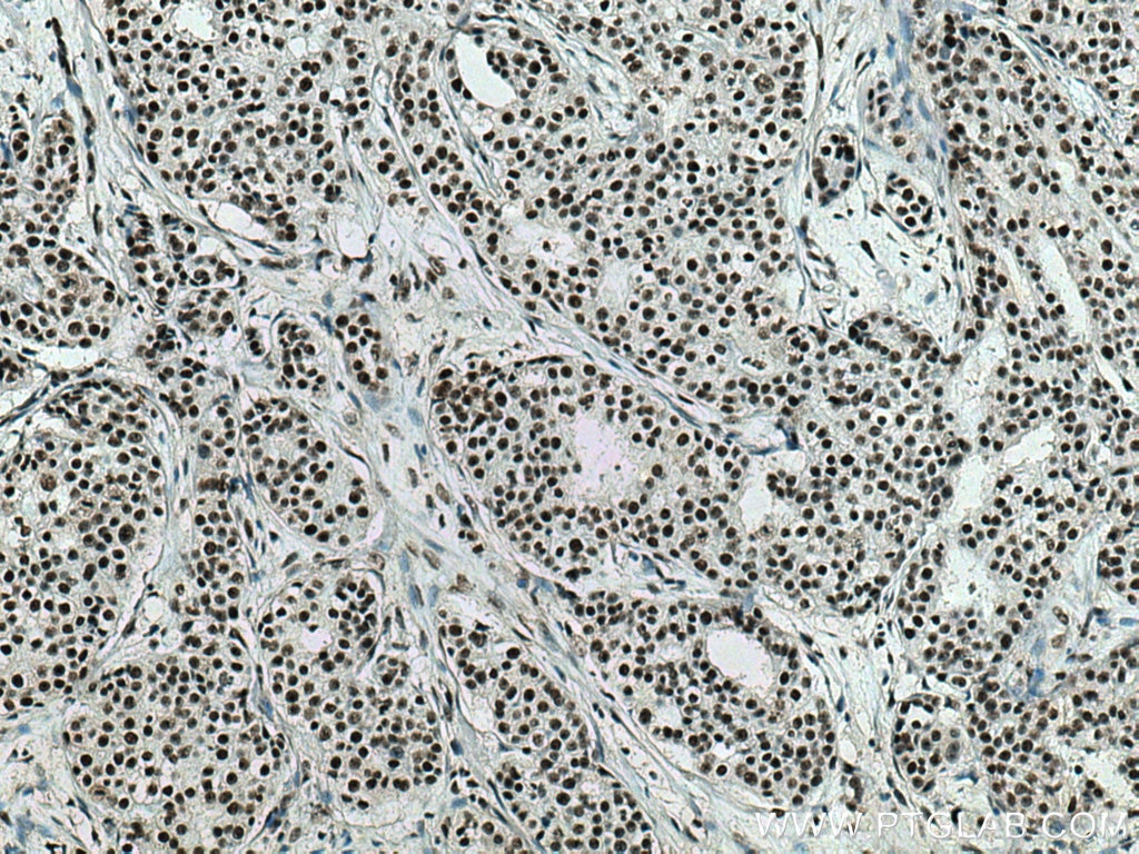 IHC staining of human breast cancer using 60289-1-Ig