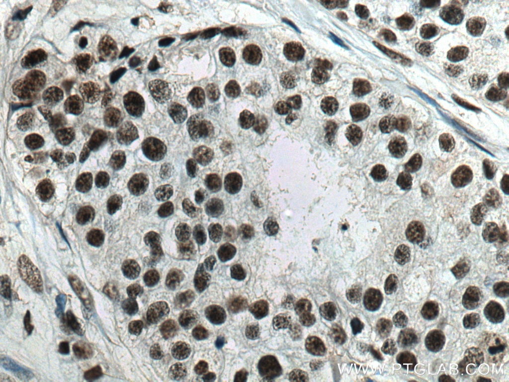 Immunohistochemistry (IHC) staining of human breast cancer tissue using U2AF35 Monoclonal antibody (60289-1-Ig)
