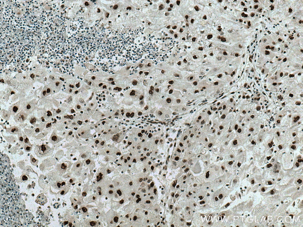 Immunohistochemistry (IHC) staining of human liver cancer tissue using U2AF35 Monoclonal antibody (60289-1-Ig)