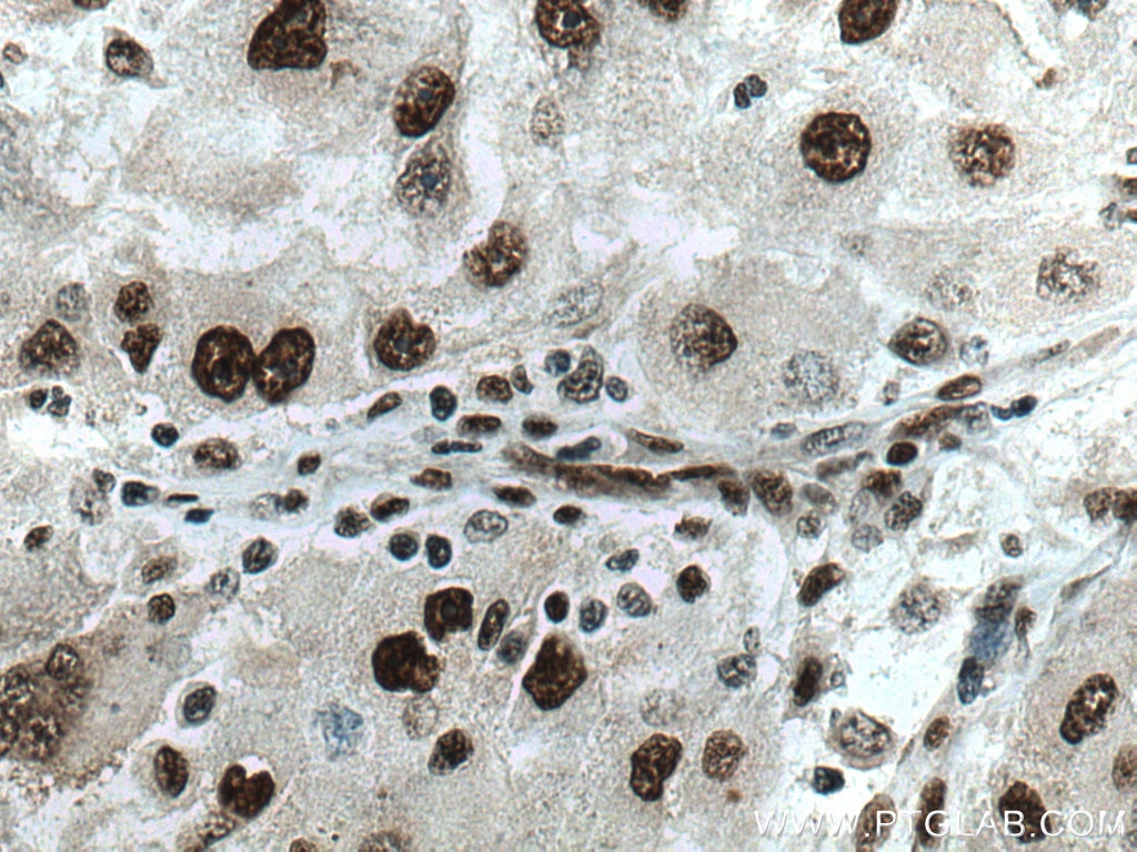 Immunohistochemistry (IHC) staining of human liver cancer tissue using U2AF35 Monoclonal antibody (60289-1-Ig)