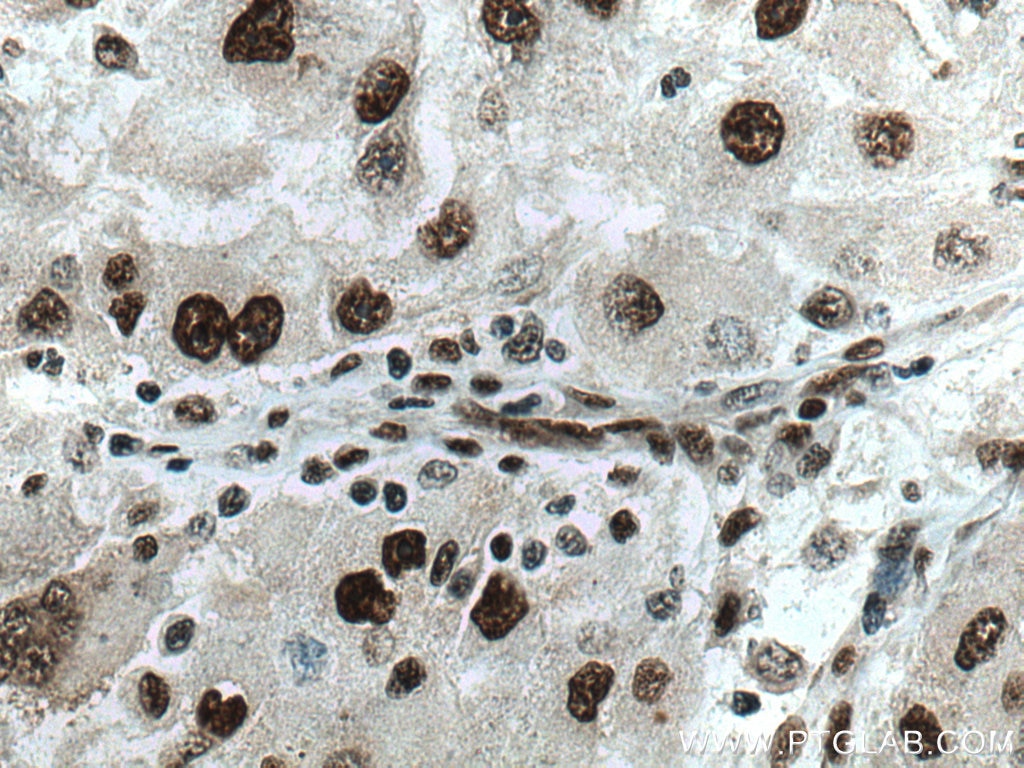 IHC staining of human liver cancer using 60289-1-Ig