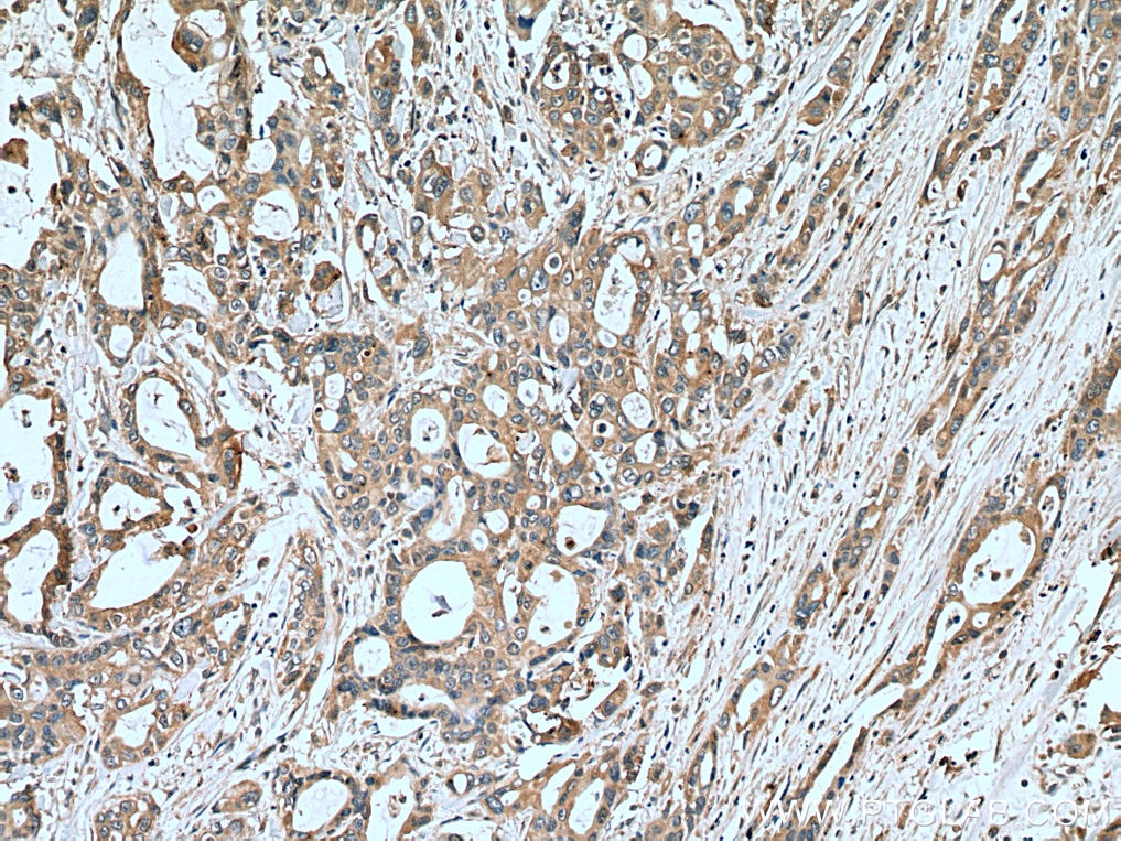 Immunohistochemistry (IHC) staining of human pancreas cancer tissue using UAP1 Monoclonal antibody (67545-1-Ig)