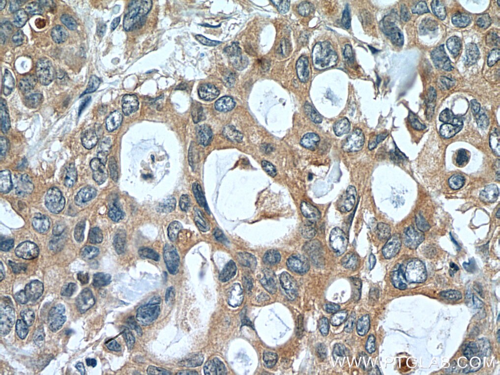 Immunohistochemistry (IHC) staining of human pancreas cancer tissue using UAP1 Monoclonal antibody (67545-1-Ig)