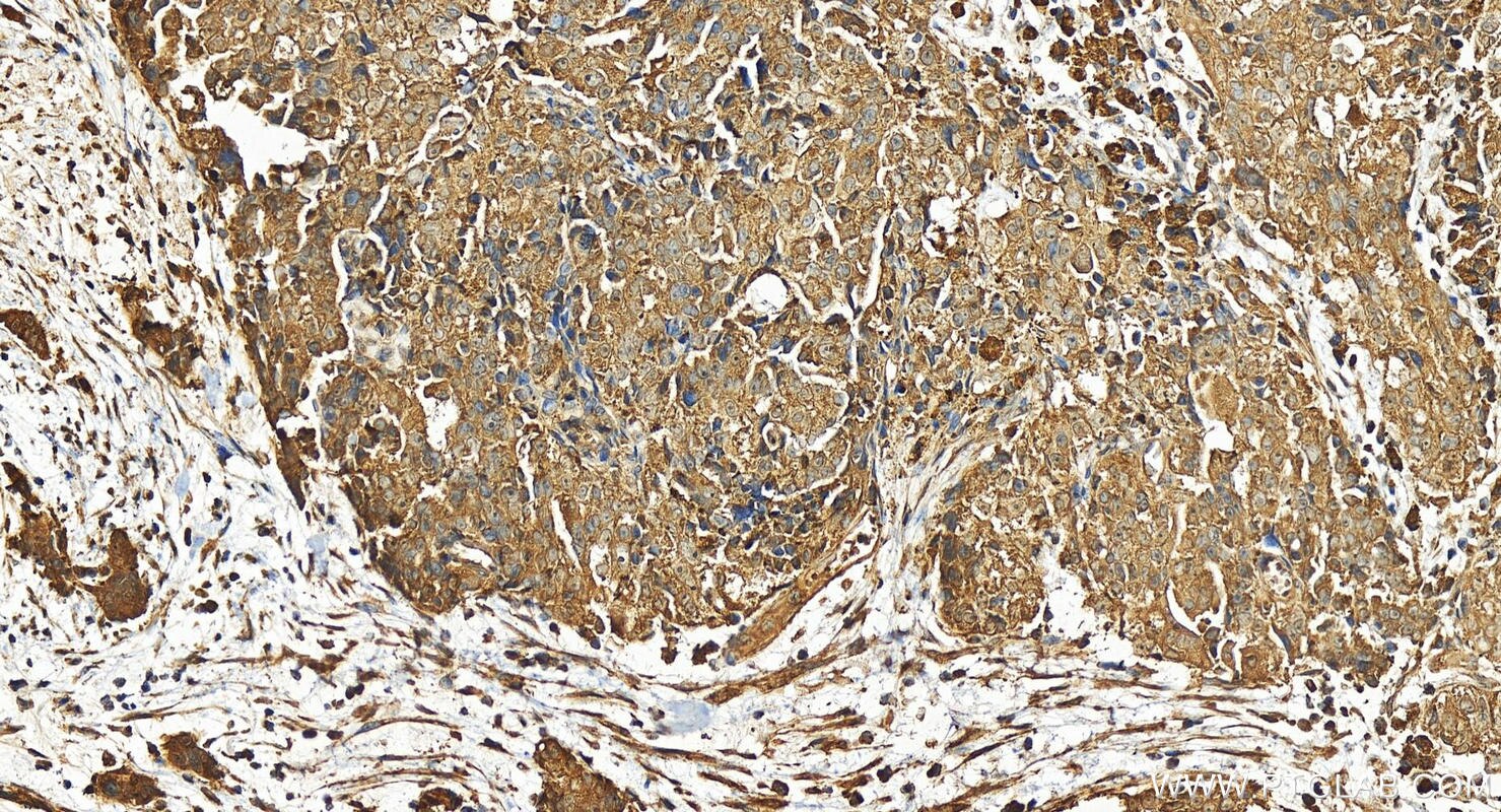 Immunohistochemistry (IHC) staining of human ovary cancer tissue using UAP1L1 Polyclonal antibody (25262-1-AP)