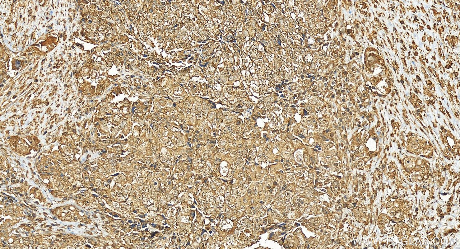 Immunohistochemistry (IHC) staining of human ovary cancer tissue using UAP1L1 Polyclonal antibody (25262-1-AP)