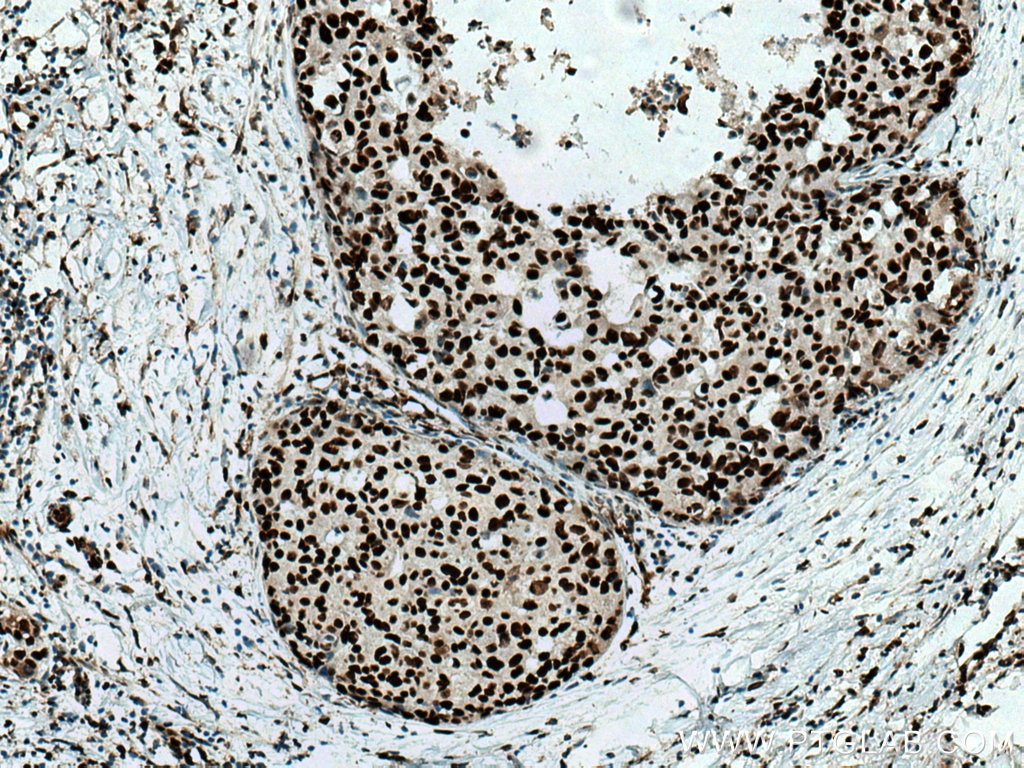 Immunohistochemistry (IHC) staining of human breast cancer tissue using UBA2 Polyclonal antibody (15347-1-AP)