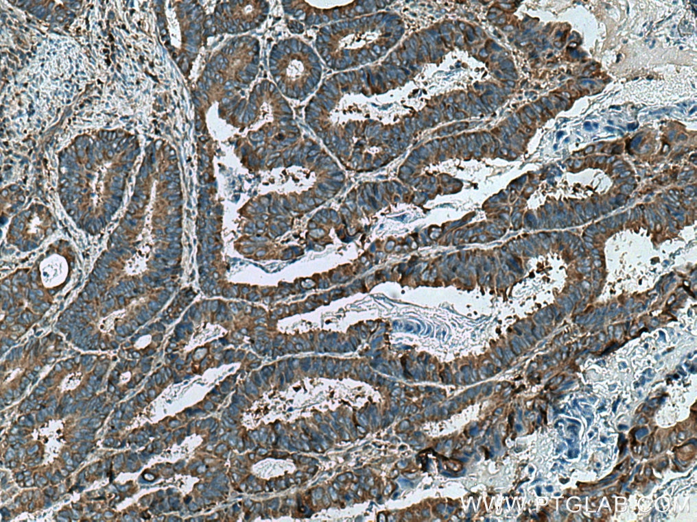 Immunohistochemistry (IHC) staining of human colon cancer tissue using UBA5 Polyclonal antibody (12093-1-AP)