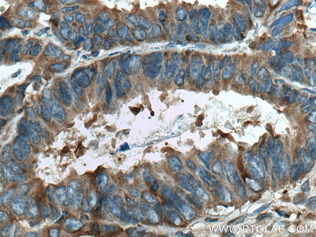 Immunohistochemistry (IHC) staining of human colon cancer tissue using UBA5 Polyclonal antibody (12093-1-AP)