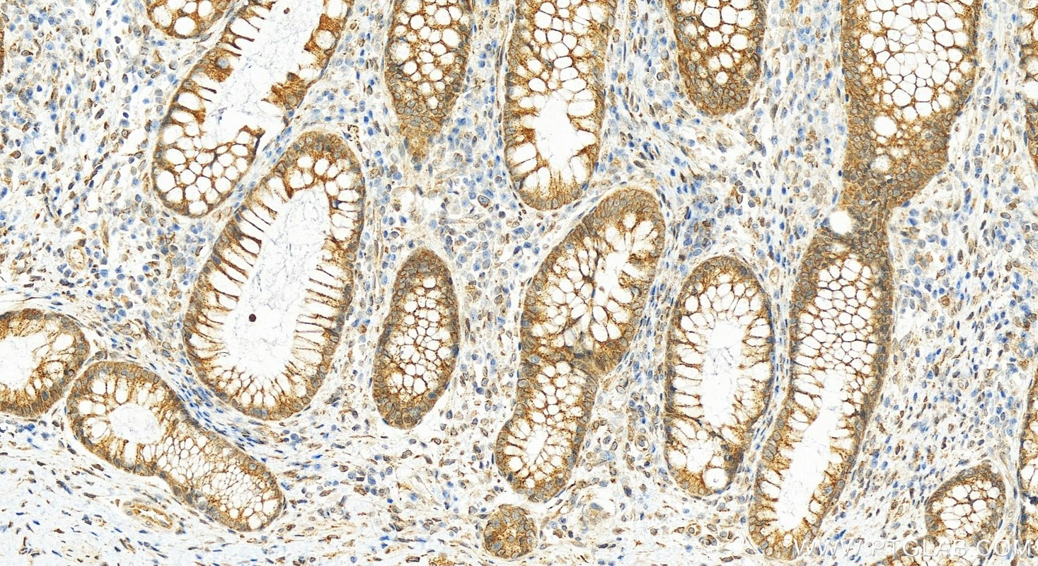 Immunohistochemistry (IHC) staining of human colon cancer tissue using UBAC2 Polyclonal antibody (25122-1-AP)