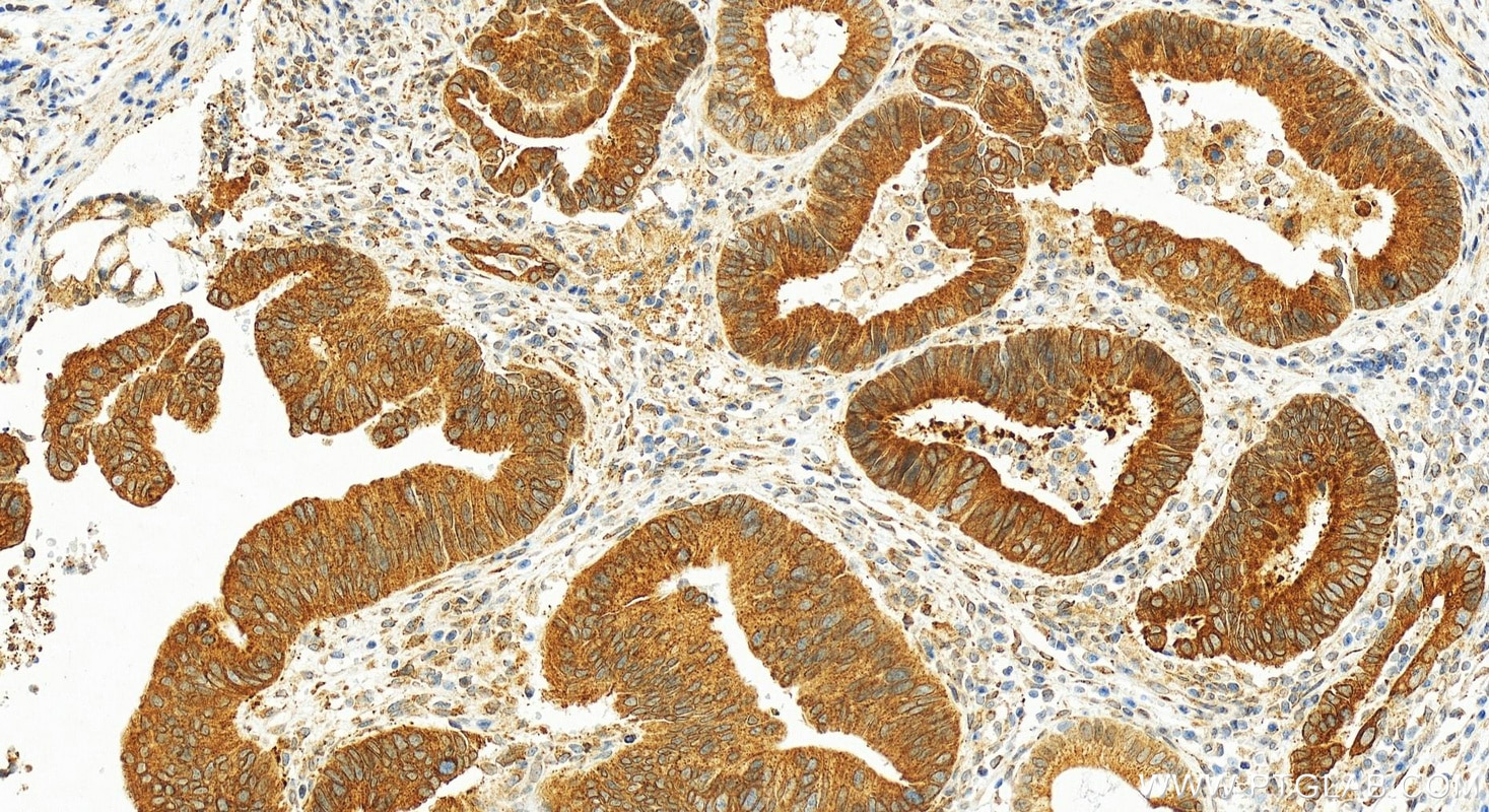 Immunohistochemistry (IHC) staining of human colon cancer tissue using UBAC2 Polyclonal antibody (25122-1-AP)