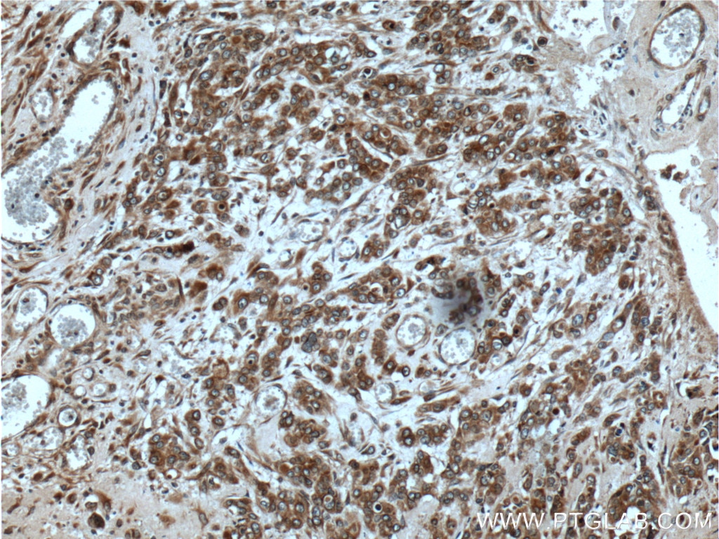 Immunohistochemistry (IHC) staining of human colon cancer tissue using UBAC2 Polyclonal antibody (25122-1-AP)