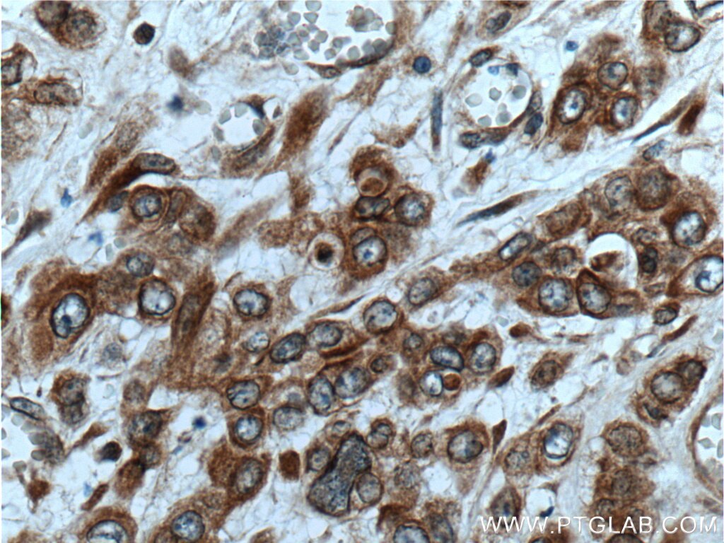 IHC staining of human colon cancer using 25122-1-AP