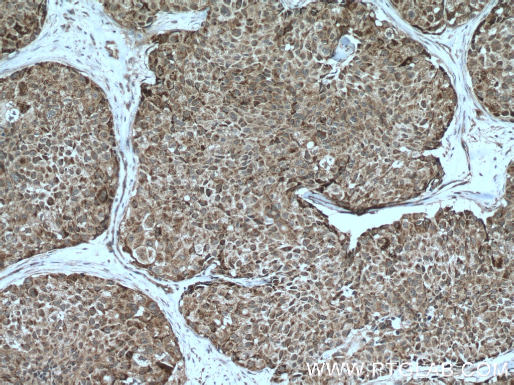 IHC staining of human lung cancer using 12385-1-AP