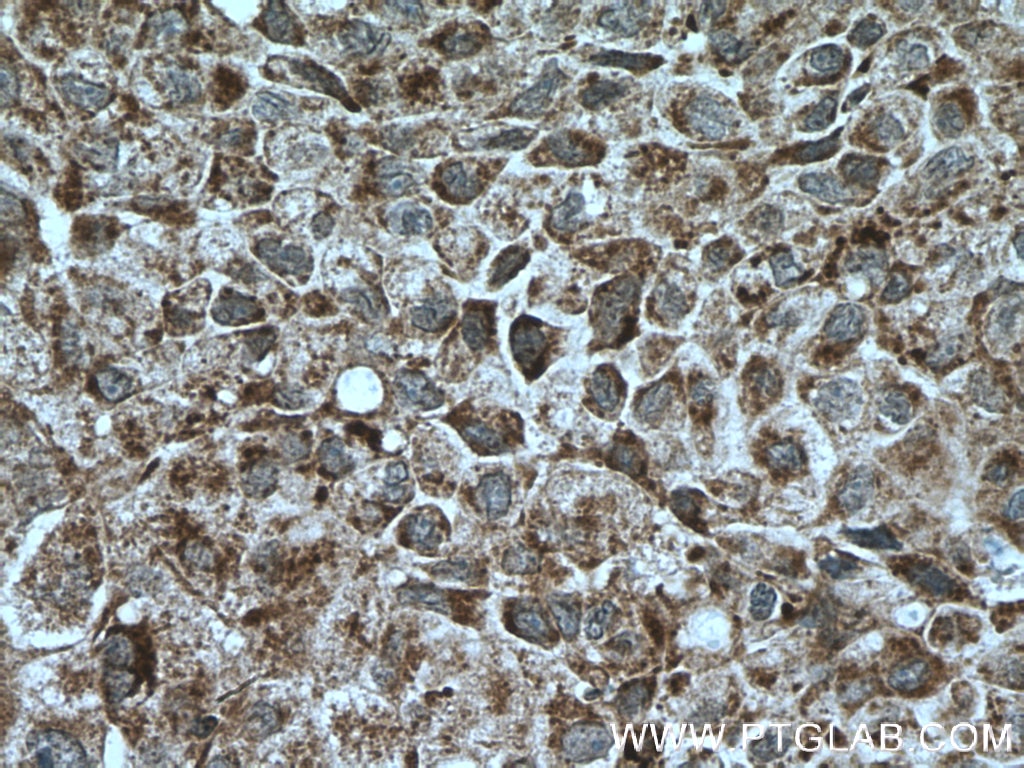 IHC staining of human lung cancer using 12385-1-AP
